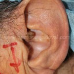 Lesió de pavelló auricular