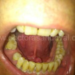 Càncer de sòl de boca