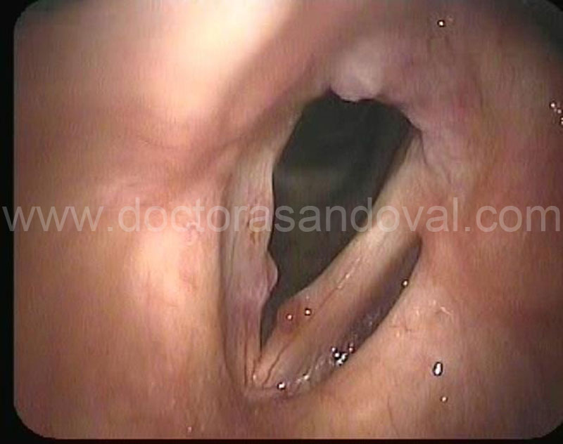 Pòlip de corda vocal
