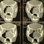 Imatge radiològica de tumoració maxiletmoidal